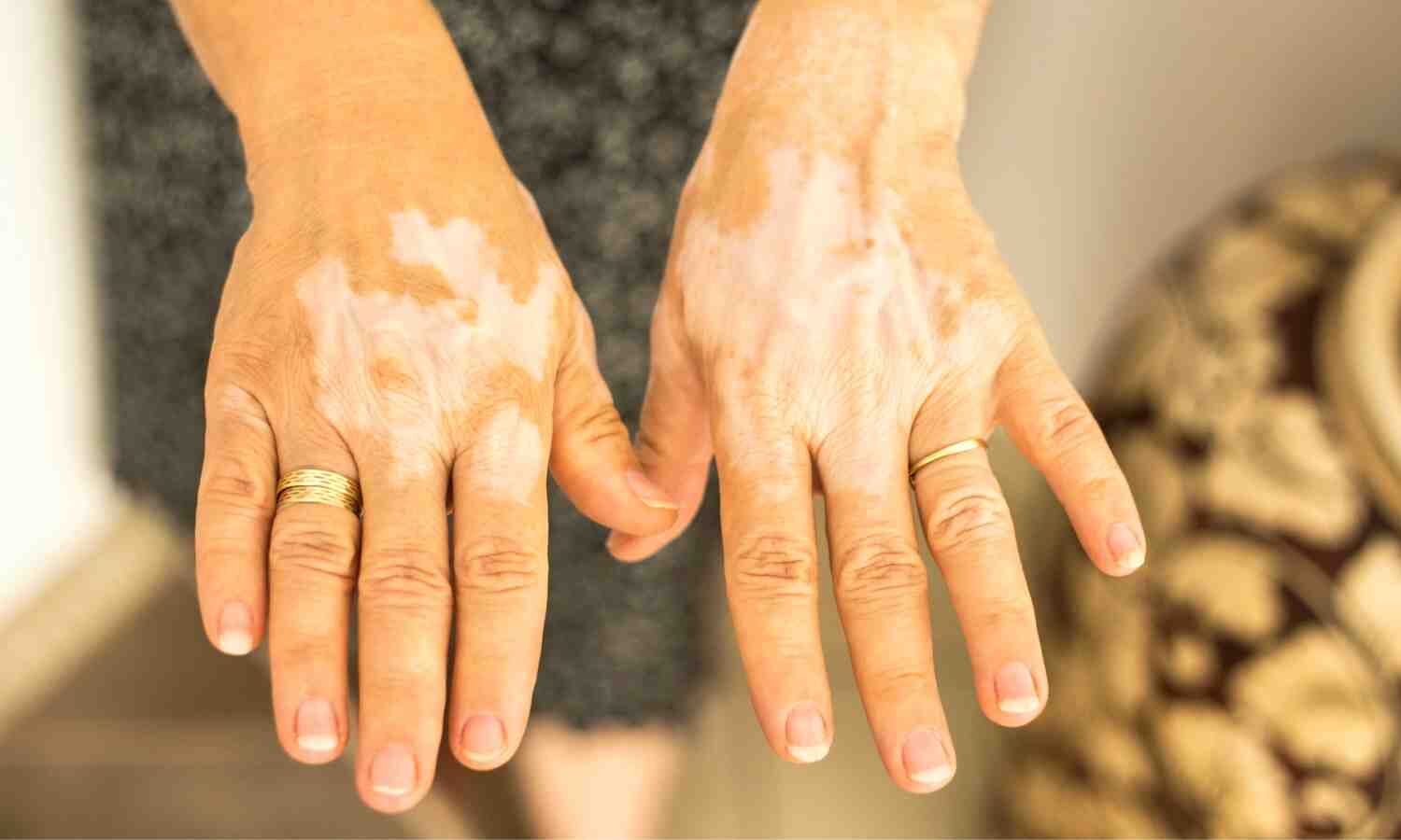 Vitiligo Causally Linked to Rheumatoid Arthritis, Type 1 Diabetes, and Alopecia Areata: Study