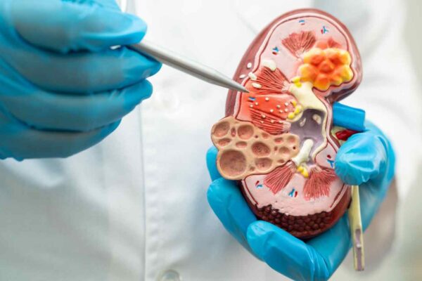 Ostomy-Related AKI Linked to Higher Mortality and MAKE Risk, suggests study