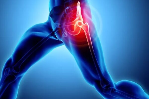 Study suggests weight loss could help treat and manage hip osteoarthritis