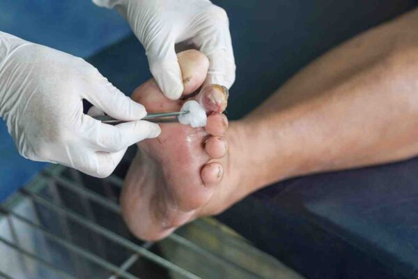 Older, White Male Smokers at Higher Risk for Diabetic Foot Ulcers: Study Older, White Male Smokers at Higher Risk for Diabetic Foot Ulcers: Study