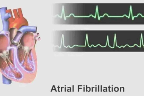 Living in a food desert doubles stroke risk for patients with atrial fibrillation, study finds