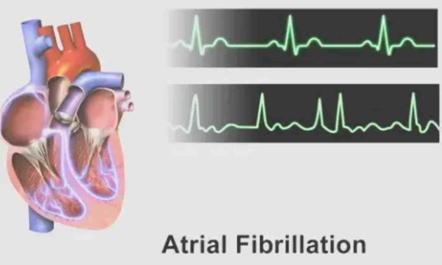 Rivaroxaban Monotherapy Effective Across Age Groups in Atrial Fibrillation Patients With Stable CAD: AFIRE Trial