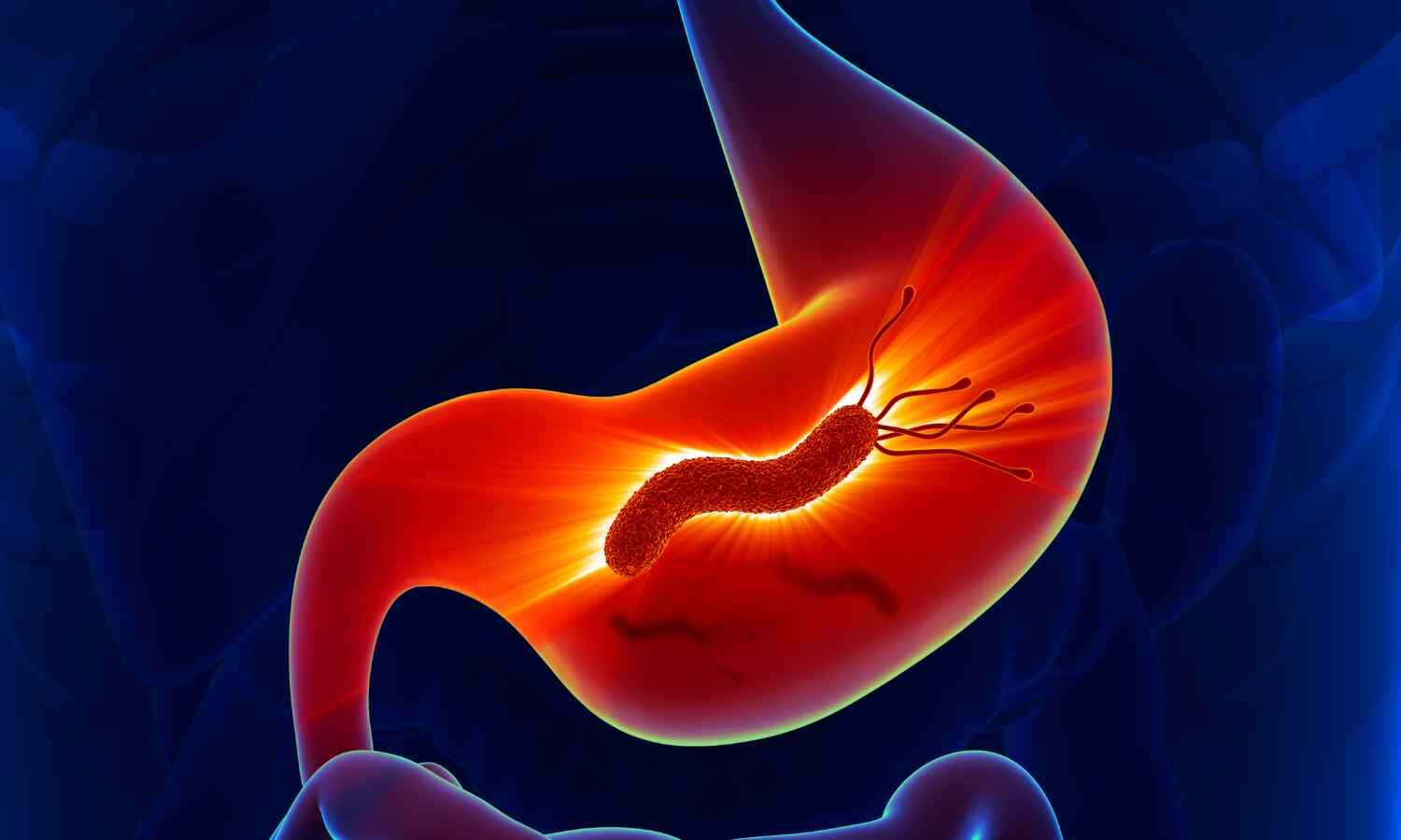 Probiotics Pretreatment Boosts H. pylori Eradication Rates and Cuts Side Effects, Meta-Analysis Finds