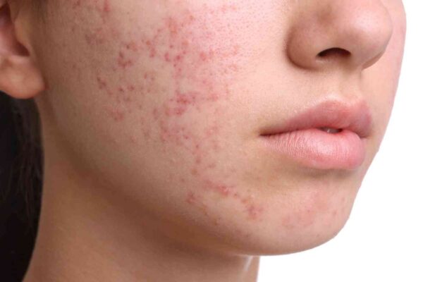 Vitamin B5 Injections Don’t Outperform Topical Therapy for Acne, Clinical Trial Reports