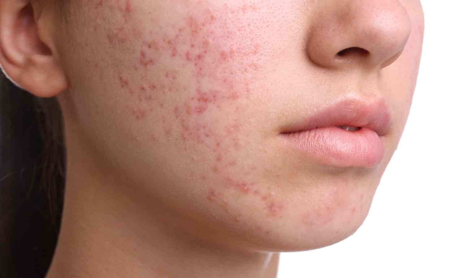Vitamin B5 Injections Don’t Outperform Topical Therapy for Acne, Clinical Trial Reports