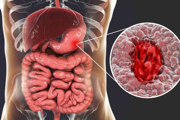 Extensive Gastric Atrophy Linked to Higher Risk of Esophageal Cancer: Study