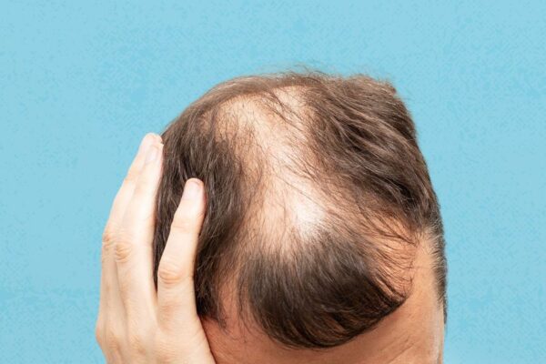 Ritlecitinib effective against moderate to severe alopecia areata over long term: Study