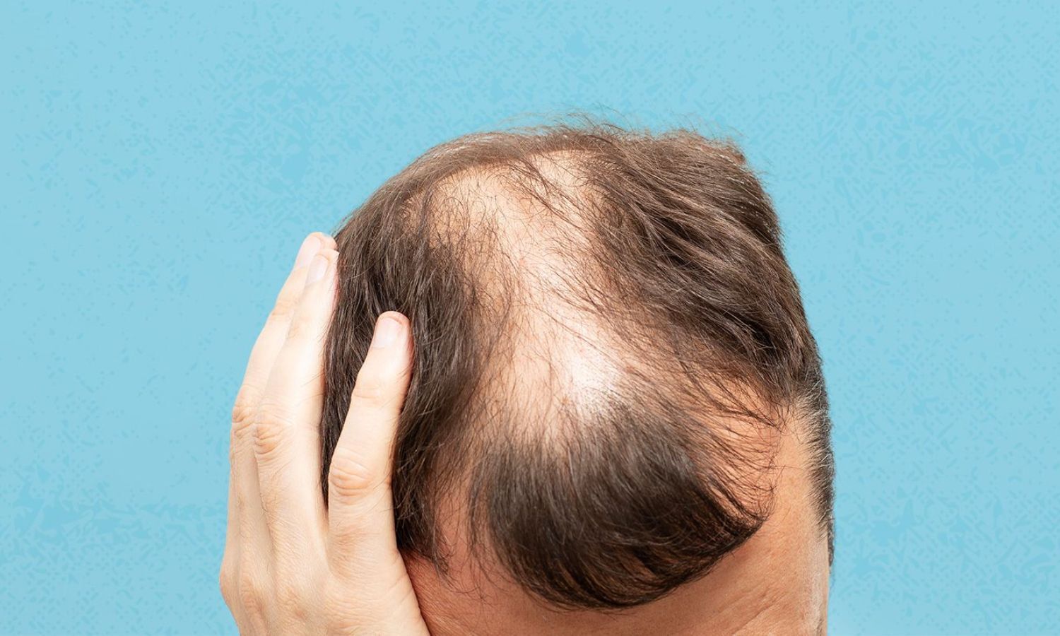 Novel dietary Supplement AGA-P Enhances Effectiveness of Parmacological Treatments for Androgenic Alopecia: Study