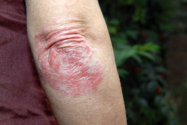 Roflumilast Cream 0.3% Safe and Effective for Plaque Psoriasis in Children Aged 2–11 Years: Study