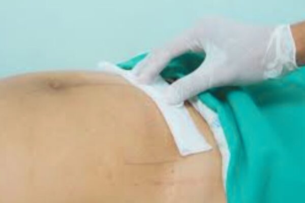 Modified open anterior mesh repair Effective for Groin Hernias in Women in Low-Resource Settings: JAMA