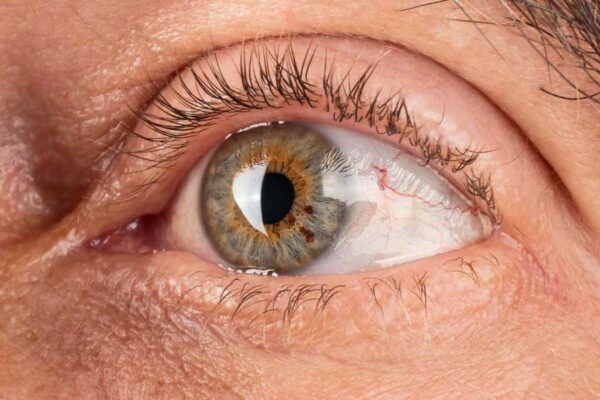 The Hidden Metabolic Story Behind Vision-Saving Treatment
