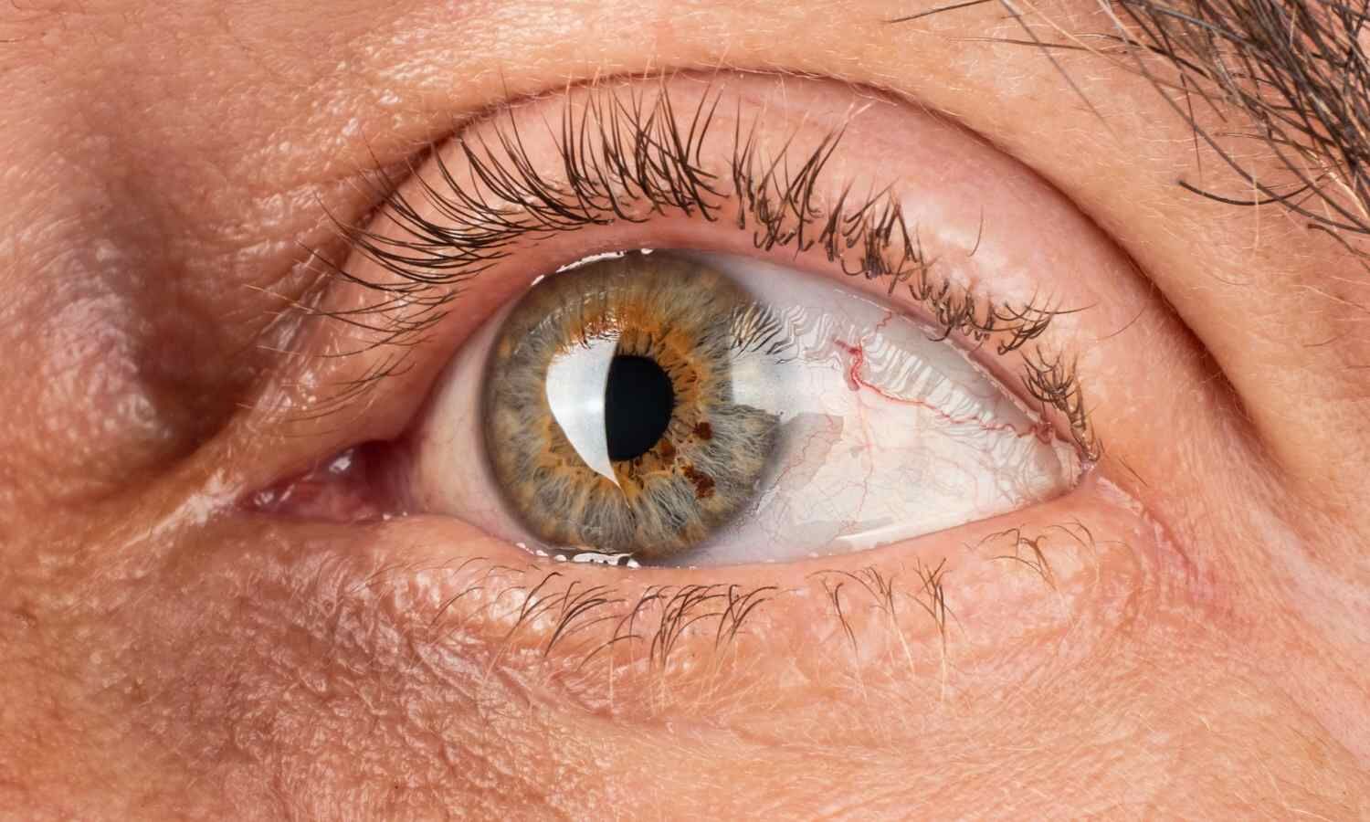 The Hidden Metabolic Story Behind Vision-Saving Treatment