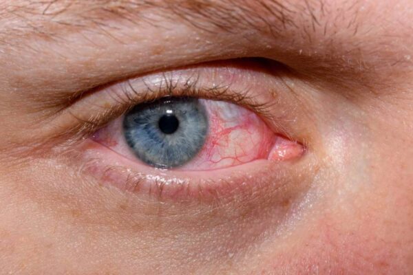 Laser correction for short-sightedness is safe and effective for older teenagers: Study