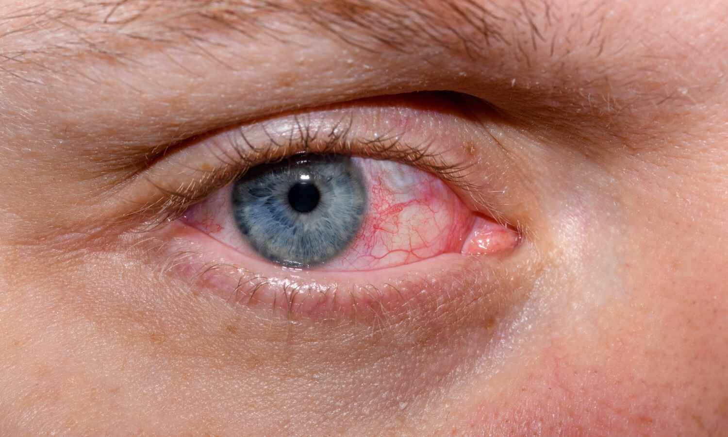 Laser correction for short-sightedness is safe and effective for older teenagers: Study