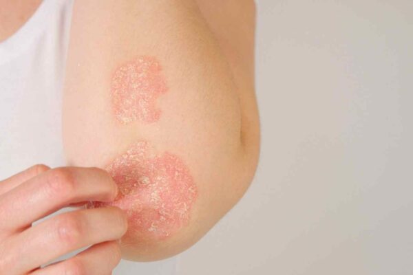 Poor Heart-Kidney-Metabolic Health and Genetics May Double Psoriasis Risk, Study Finds