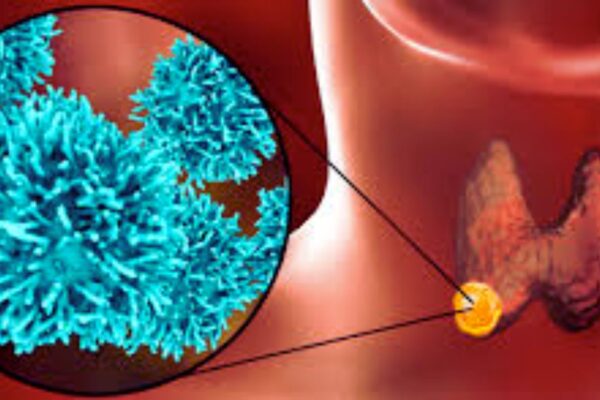 Pembrolizumab Significantly Improves Event-Free Survival in Head and Neck Cancer: NEJM