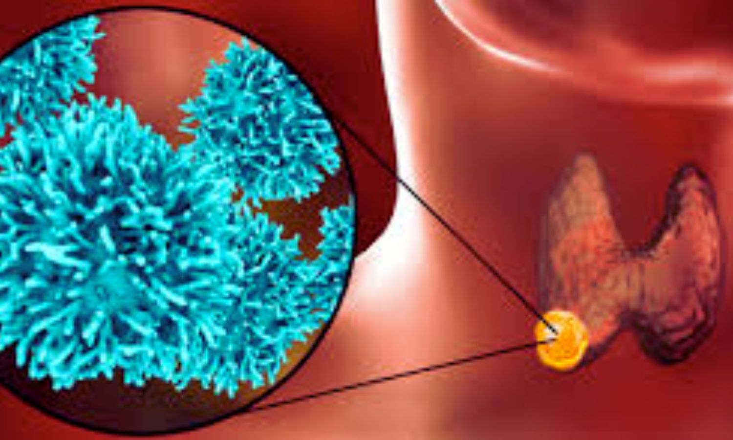 Pembrolizumab Significantly Improves Event-Free Survival in Head and Neck Cancer: NEJM