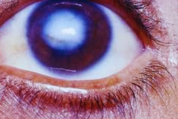 University of Houston optometry researcher provides new hope for injured corneas University of Houston optometry researcher provides new hope for injured corneas