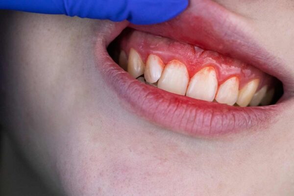 Gum Disease Linked to Increased Risk of Gestational Diabetes: Study Gum Disease Linked to Increased Risk of Gestational Diabetes: Study