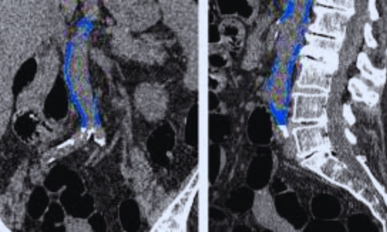 Poor Sleep Patterns Linked to 65 Percent Higher Risk of Abdominal Aortic Calcification in Adults: Study Finds