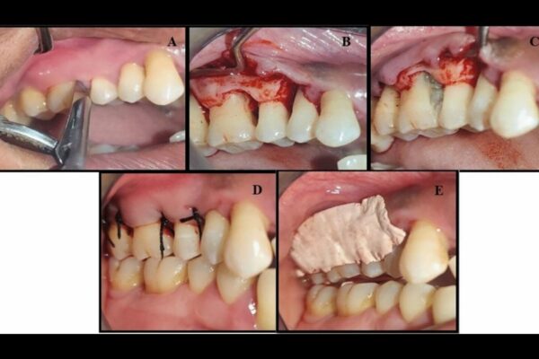 Placental Extract Gel Enhances Periodontal Healing; Periostin Emerges as Promising Biomarker: Study Placental Extract Gel Enhances Periodontal Healing; Periostin Emerges as Promising Biomarker: Study