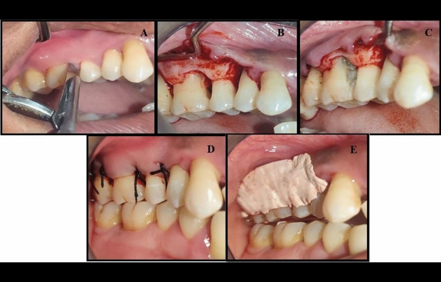 Placental Extract Gel Enhances Periodontal Healing; Periostin Emerges as Promising Biomarker: Study