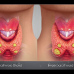 Sunlight Exposure May Reduce Risk of Postoperative Hypoparathyroidism, suggests study