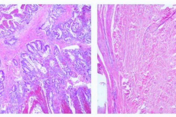 Rare Case Links Peutz-Jeghers Syndrome to Kidney Anomaly, Suggests Broader Screening and STK11 Role