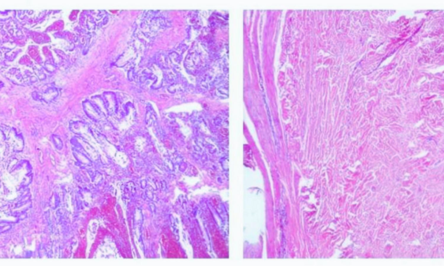 Rare Case Links Peutz-Jeghers Syndrome to Kidney Anomaly, Suggests Broader Screening and STK11 Role