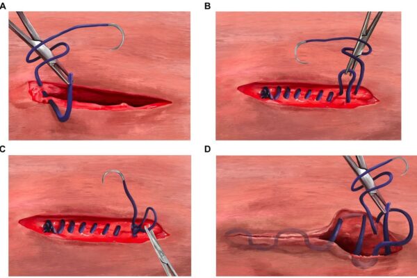 Barbed Sutures Improve Laparoscopic Tubal Anastomosis Outcomes, suggests study