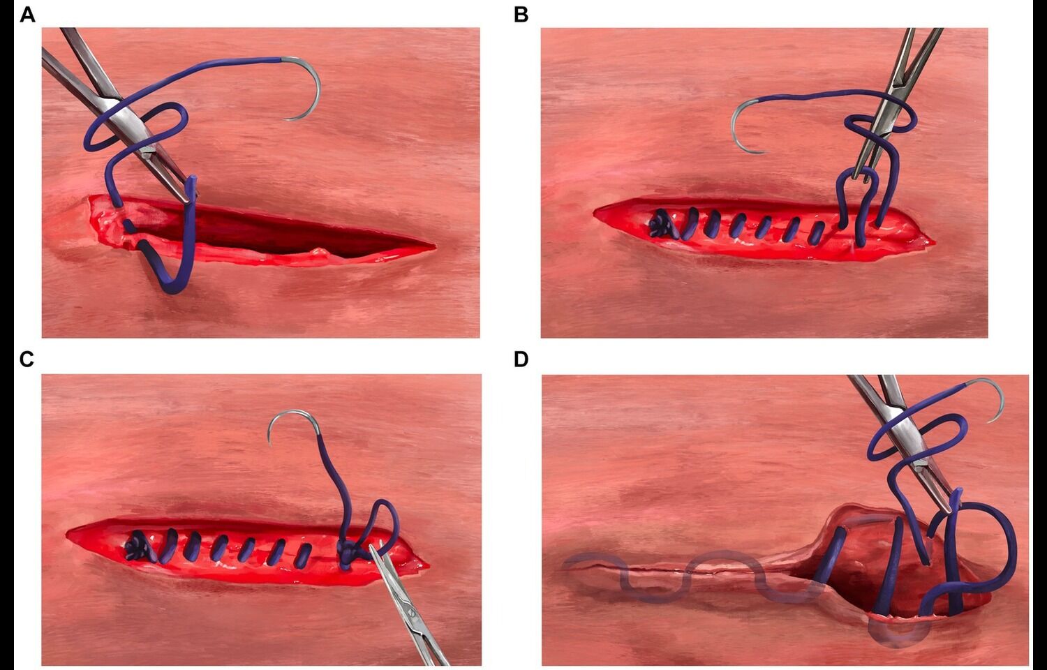 Barbed Sutures Improve Laparoscopic Tubal Anastomosis Outcomes, suggests study