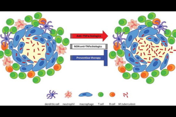 Increased TB Risk in Psoriasis Patients on Etanercept Despite Isoniazid Prophylaxis: Study