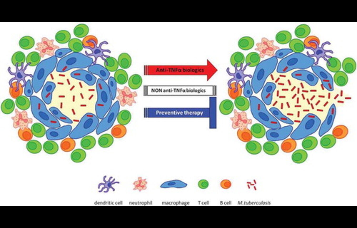 Increased TB Risk in Psoriasis Patients on Etanercept Despite Isoniazid Prophylaxis: Study
