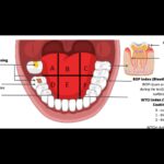 DMFT Score associated with increased risk of Buccal Mucosa Cancer: Study