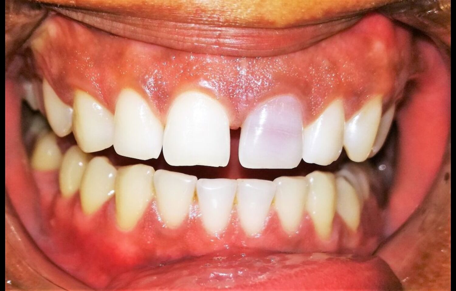 Application of Fluoride Varnish after Bleaching may Reduce Early Discoloration, suggests study