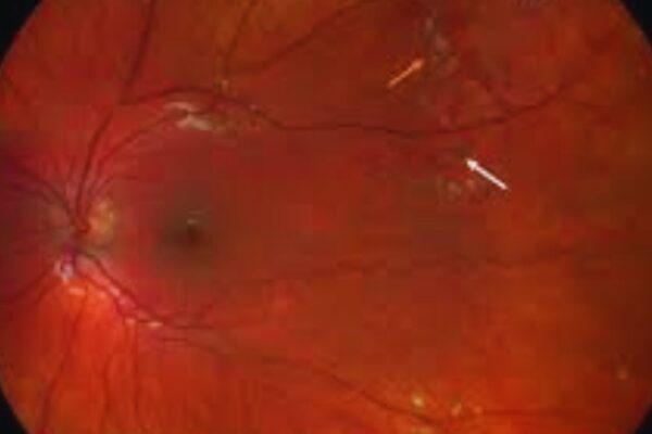 Dexamethasone Implant Promising as Adjunctive Therapy in Coats’ Disease: Study Finds