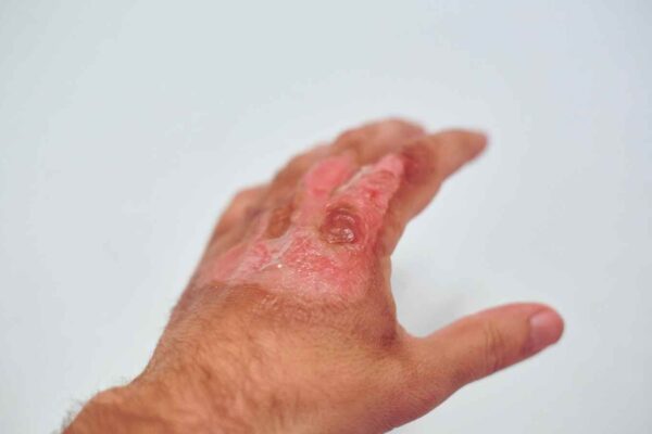 PRP Found Effective in Enhancing Wound Healing in Burn Patients: Study PRP Found Effective in Enhancing Wound Healing in Burn Patients: Study
