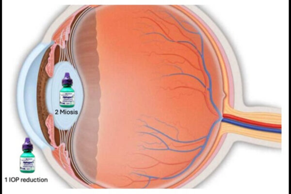 Alphagan-P Shows Promise in Correcting Post-LASIK Low Residual Myopia : Study Alphagan-P Shows Promise in Correcting Post-LASIK Low Residual Myopia : Study