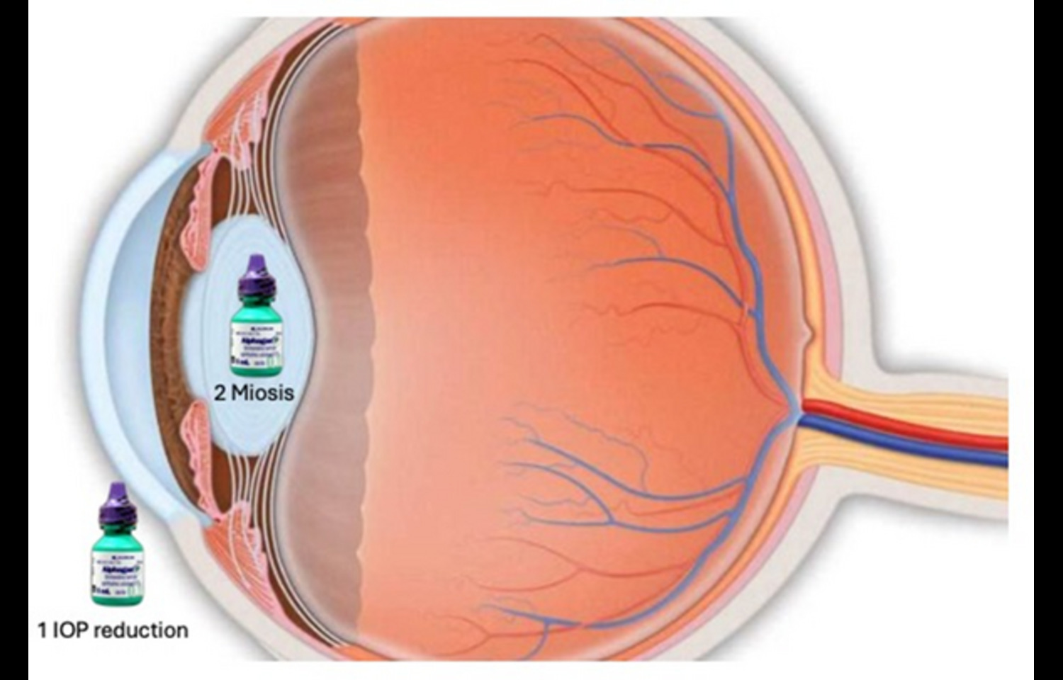 Alphagan-P Shows Promise in Correcting Post-LASIK Low Residual Myopia : Study
