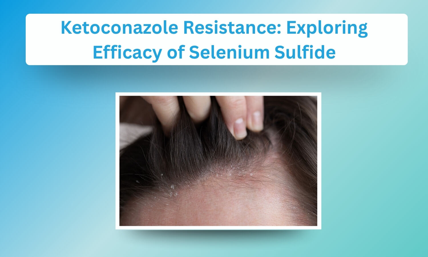 Exploring the Efficacy of Selenium Sulfide in Resistant Cases