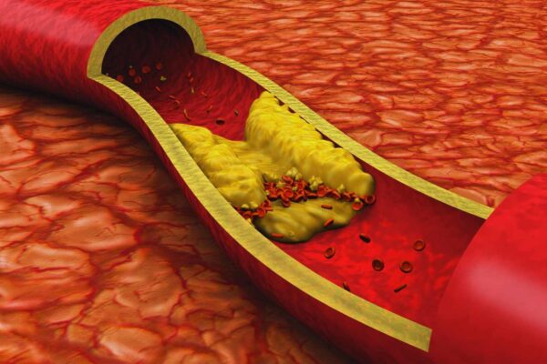 FDA Approves Inclisiran as First-Line LDL-C Treatment Without Statins