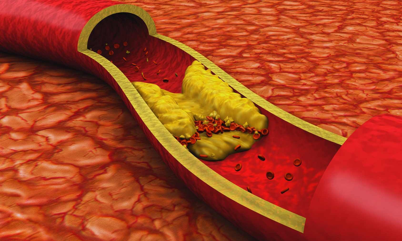 FDA Approves Inclisiran as First-Line LDL-C Treatment Without Statins