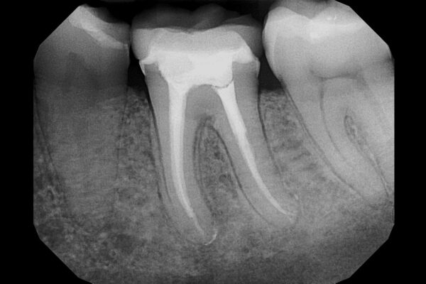 Rotary Instrumentation May Improve Pediatric Root Canal Outcomes, but Standardized Research Needed: Study Rotary Instrumentation May Improve Pediatric Root Canal Outcomes, but Standardized Research Needed: Study