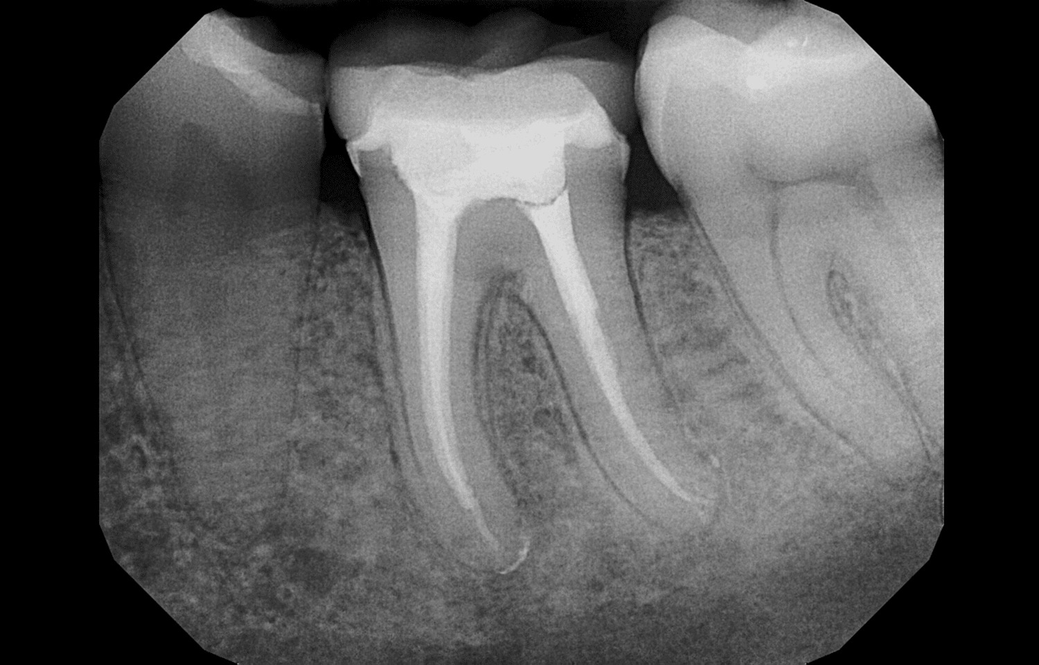 Rotary Instrumentation May Improve Pediatric Root Canal Outcomes, but Standardized Research Needed: Study