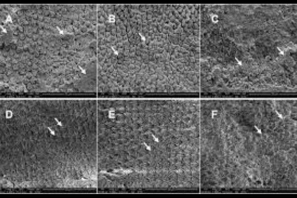 YAG Laser Plus 60s Acid Etch Restores Bonding in Fluorotic Enamel: Study