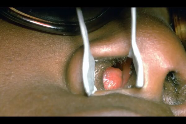 Stapokibart Reduces Size and Symptoms of Nasal Polyps in Severe Chronic Rhinosinusitis: JAMA