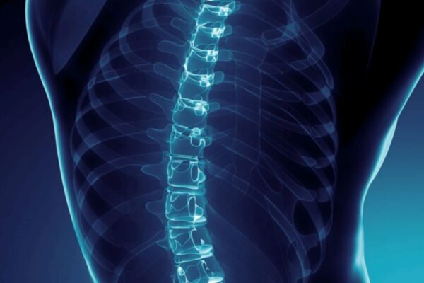 Conus Medullaris Level Not Linked to CSF Leak Risk in Spinal Surgery, Finds Study
