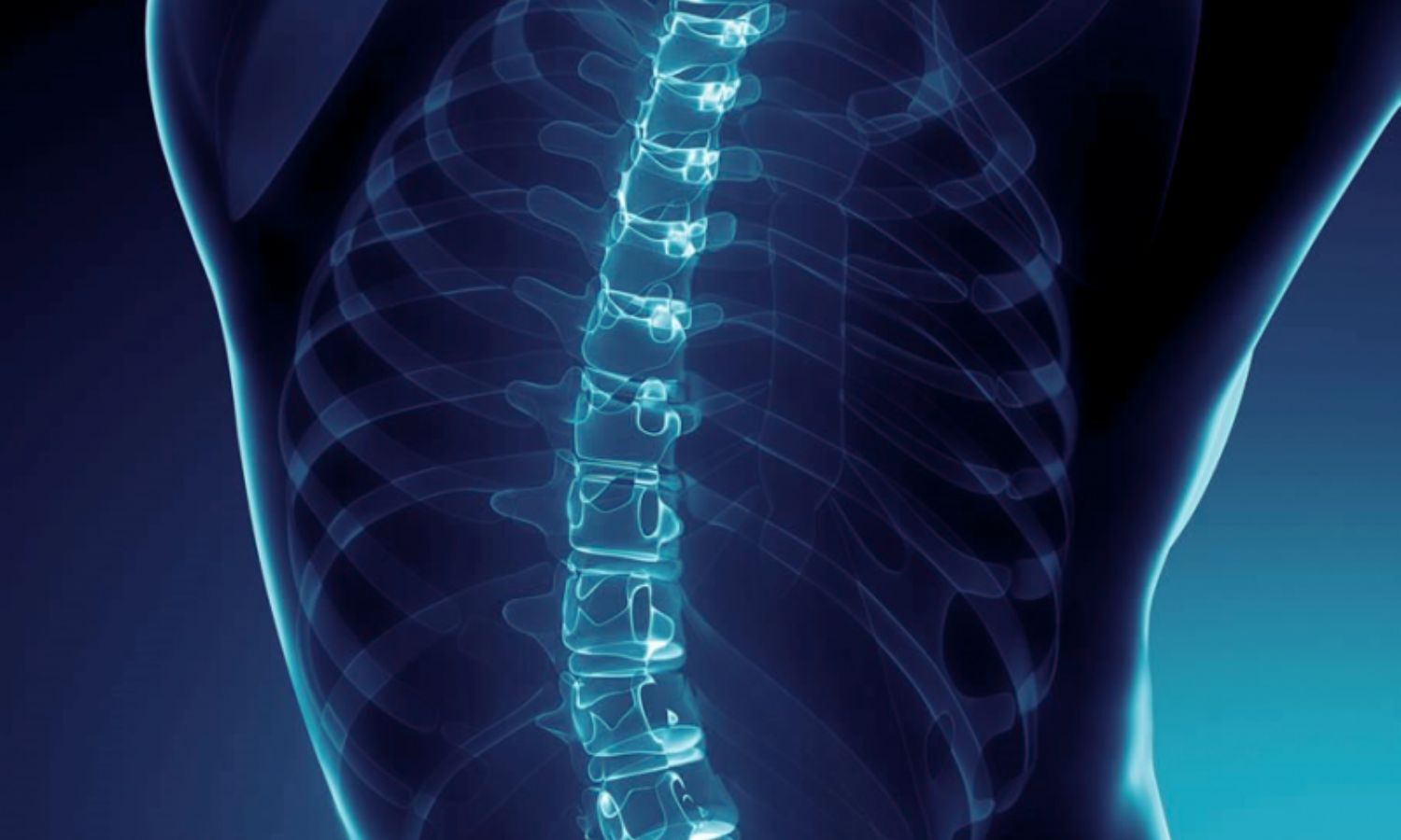 Conus Medullaris Level Not Linked to CSF Leak Risk in Spinal Surgery, Finds Study