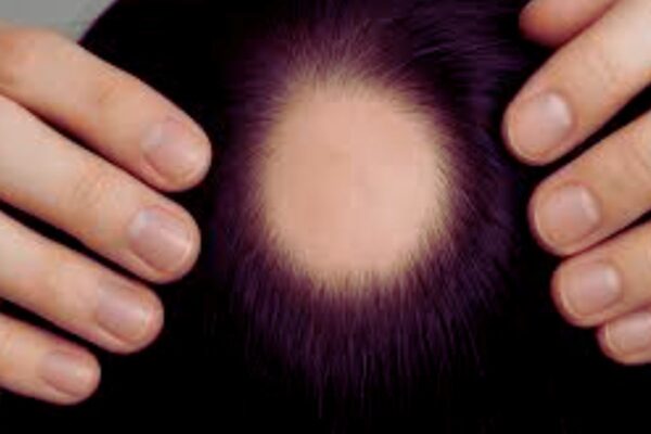 Low-Dose Oral Minoxidil for Hair Loss Not Linked to Tachycardia, Large Study Suggests