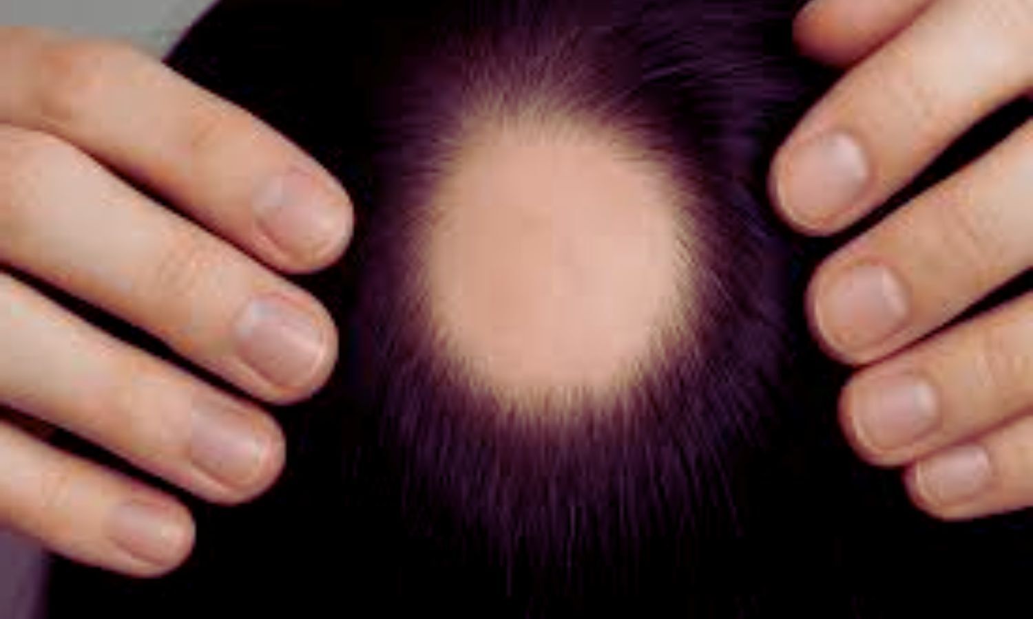 Low-Dose Oral Minoxidil for Hair Loss Not Linked to Tachycardia, Large Study Suggests